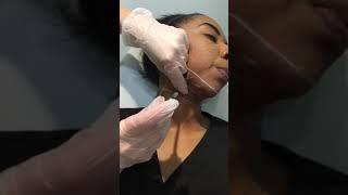 Kybella Injection at Suddenly Slimmer Med Spa in Phoenix