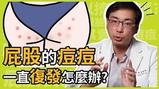 屁股痘痘一直長、一直復發怎麼辦？怎麼保養才不會色素沉澱？皮膚科林政賢醫師美尻保養日記！