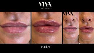 Lip Filler Before and after  #lipfiller #lipfillerinjections #lipfillers #lipstick #lips #beauty