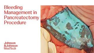 Pancreatectomy Procedure with ETHIZIA Hemostatic Sealing Patch | J&J MedTech