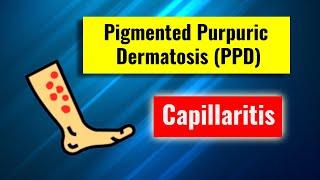 Pigmented purpuric dermatosis, Capillaritis: overview, clinical features, histology and management