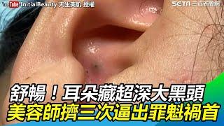 舒暢！耳朵藏超深大黑頭　美容師大擠三次逼出罪魁禍首｜三立新聞網SETN.com