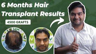 Best Hair Transplant in Guwahati | Best Hair Transplant Result & Cost in Guwahati