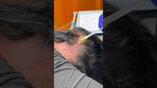 PRP Injections & Micro-needling for Hairloss