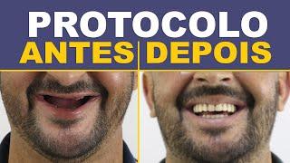 8 Casos de Implantes Protocolo - Antes e Depois!