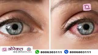 What to do after one eye cataract surgery  | Dr. Girjesh Kain Eye Specialist #youtube #trending