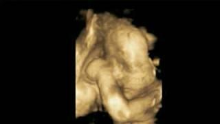 3D/4D Pregnancy Ultrasound Scan, www.Ultrasound.ie, Blackrock Dublin Ireland