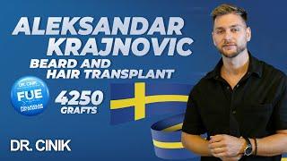 Aleksandar Krajnovic | Beard and Hair Transplant | Dr. Cinik