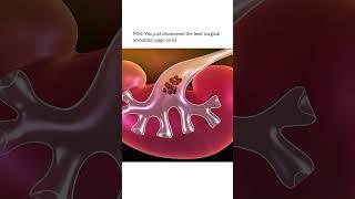 lithotripsy
