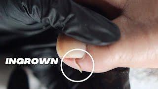 DIY INGROWN TOENAIL PEDICURE AT HOME //  Relaxing Pedicure