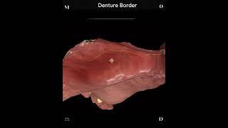 Denture Borders from a digital impression!