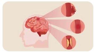 BRAIN STROKE SEQUENCES IN MRI... RADIOLOGY...