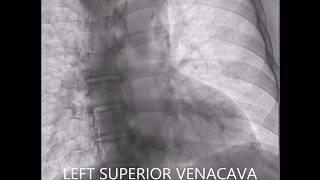 BILATERAL SUPERIOR VENACAVA