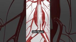 Reinforcing a weak aorta to prevent rupture (3D animation)