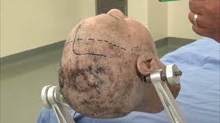 Skull Clamp Placement: Frontal Craniotomy-Incision (Preview)