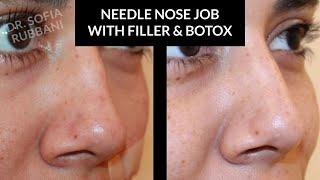 BEFORE & AFTER - Needle Nose Job (After 3 Sessions) by Dr. Rubbani