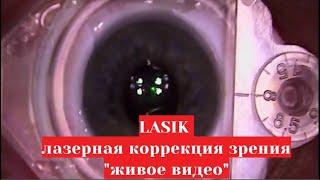 ЛАСИК  - "живое" видео  операции лазерной коррекции зрения по методу LASIK в Москве
