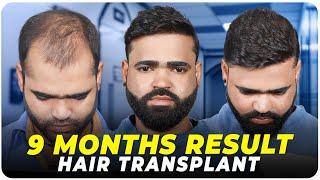 Hair Transplant in Bikaner | Best Results & Cost of Hair Transplant in Bikaner