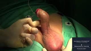 Surgical Treatment of Bent Penis due to Peyronie's disease