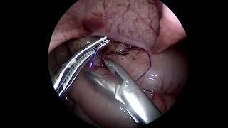 Colonic Biopsy laparoscopic technique