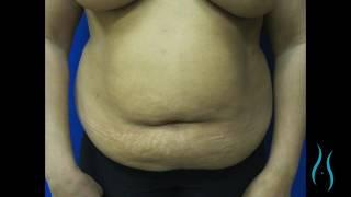 Abdominoplasty in Connecticut