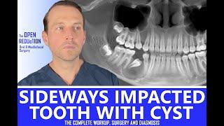 IMPACTED TOOTH with a CYST