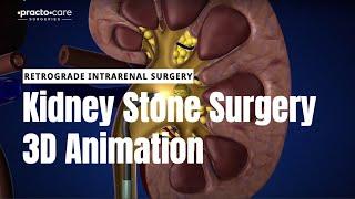 गुर्दे की पथरी (kidney stones) की सर्जरी (surgery) कैसे होती हैं?