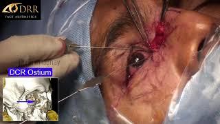 Traumatic Telecanthus repair using transnasal wiring technique - Demonstrated by Dr.Priti Udhay