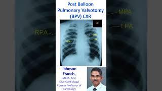 Post balloon pulmonary valvotomy (BPV) X-ray chest PA view