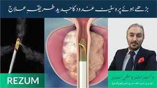 REZUM | بڑھے ہوئے پروسٹیٹ کا جدید طریقہ علاج |  Treatment And Benefits |By Dr. Fartash Sarwar