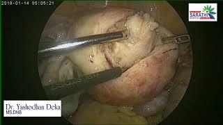 LAPAROSCOPIC SUBMUCOSAL FIBROID REMOVAL with explaination of the procedure