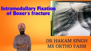 IDEAL WAY FOR BOXER'S FRACTURE FIXATION. DR HAKAM SINGH