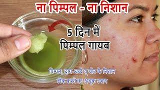 पुराने से पुराने पिम्पल्स,दाग-धब्बे व किसी भी तरह के निशान हटाए | Remove Pimple - Acne Treatment