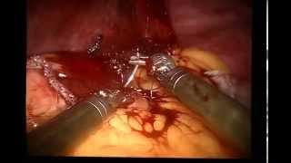 Robotic sleev gastrectomy. Продольная (рукавная, вертикальная) гастропластика.