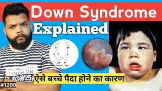 Down Syndrome Explain In Hindi | Causes, Symptoms, Treatment