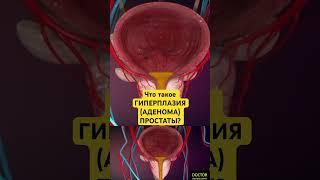 Что такое ГИПЕРПЛАЗИЯ (АДЕНОМА) ПРОСТАТЫ?