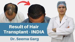 Hair Transplant in India | Delhi Hair Transplant Clinic | Dr. Seema Garg
