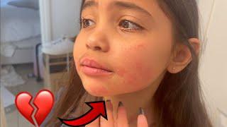 AVA GETS A HORRIBLE RASH ON HER FACE! SHOCKING!