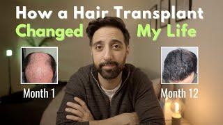 How Two Hair Transplants Changed My Life