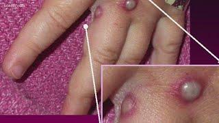 What to know about Monkeypox with Dr. Lucia