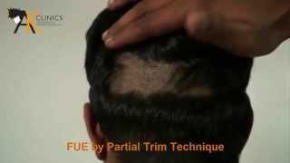 FUE Hair Transplant in Delhi - Partial Trim - AK Clinics