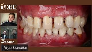 محاضرة قوية  The way to perfect restorations   د أحمد ماهر    د عمار قاسم