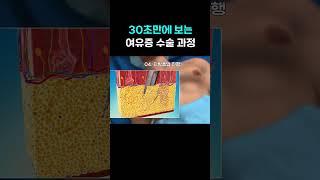 30초만에 보는 여유증 수술 과정 #여유증 #남자 #수술