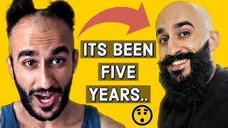 It's Been 5 YEARS Since I Shaved My Head & Embraced My Hair Loss - Was It Worth It..?