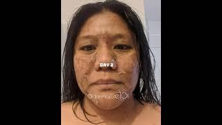 10 days skin peeling journey with Marivi by Gwen K