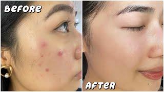 HOW I CURED MY ACNE | Products For Acne Scars/Marks/Pigmentation | AFFORDABLE & EFFECTIVE