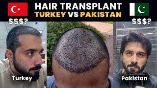 Hair Transplant Cost & Pricing  In Turkey & Pakistan | My Personal Experience