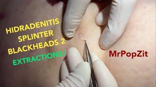 HIDRADENITIS causes splinter blackheads.Watch me pull out the plugs from her armpits.Instant relief!