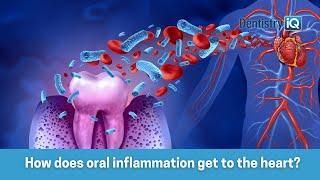 How inflammation in your mouth gets into your heart