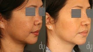 Asian Rhinoplasty | Before & After | Diced Cartilage Fascia (DCF) - Beverly Hills